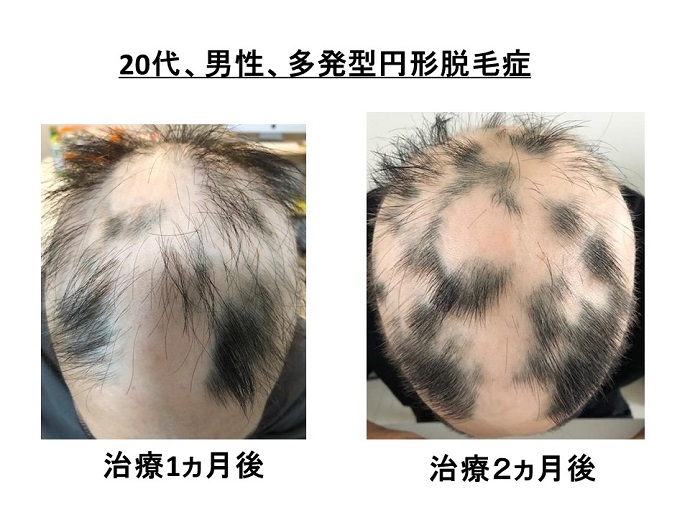 円形脱毛症　病院